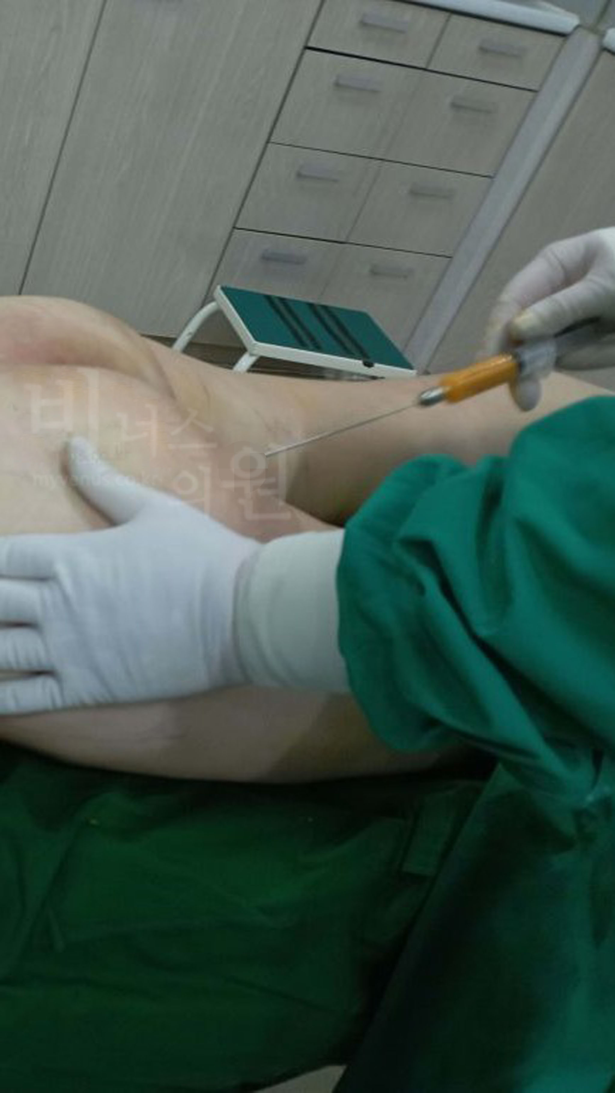 허벅지 엉덩이 지방이식.jpg