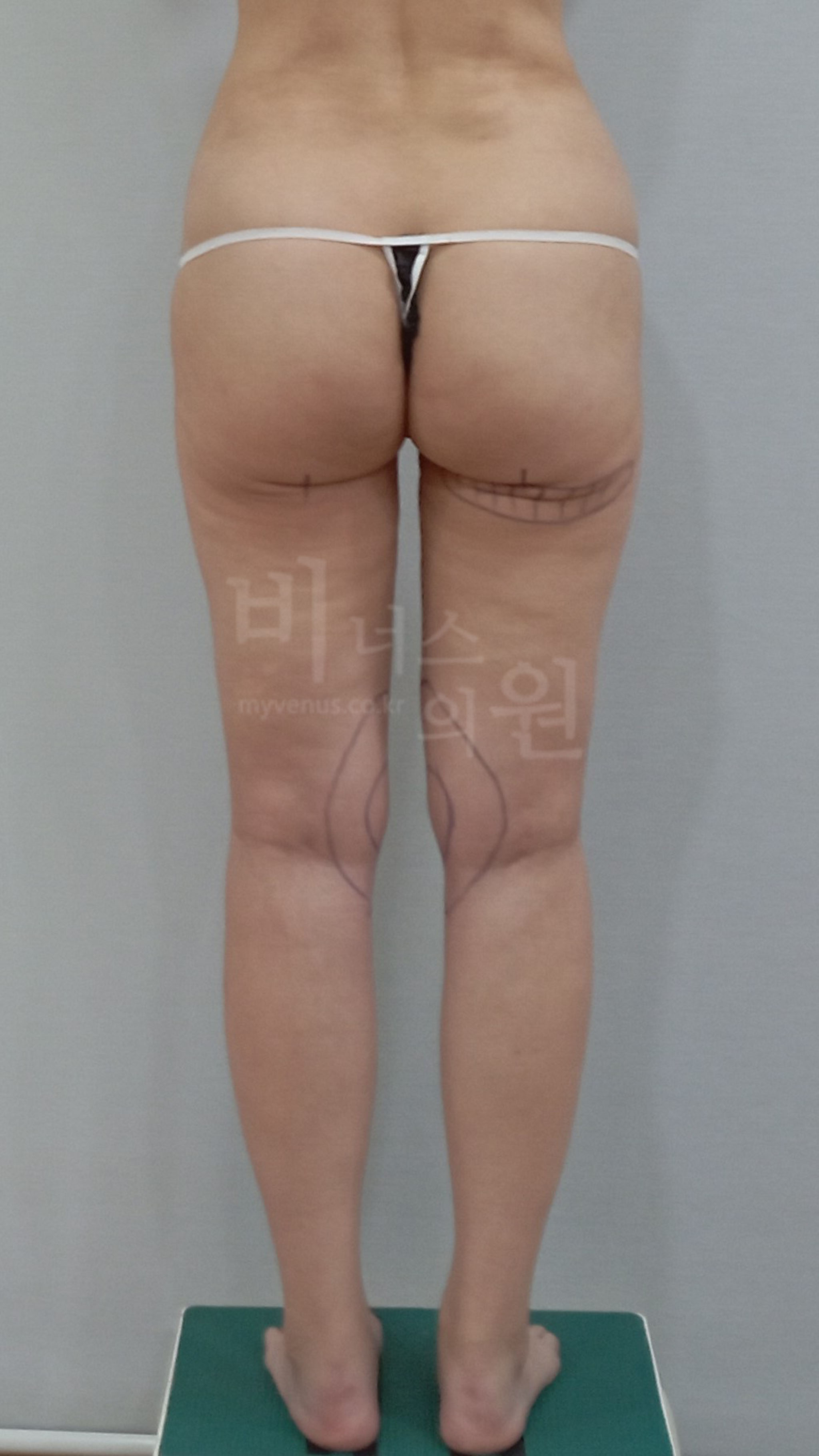 무릎 안쪽 지방흡입.jpg