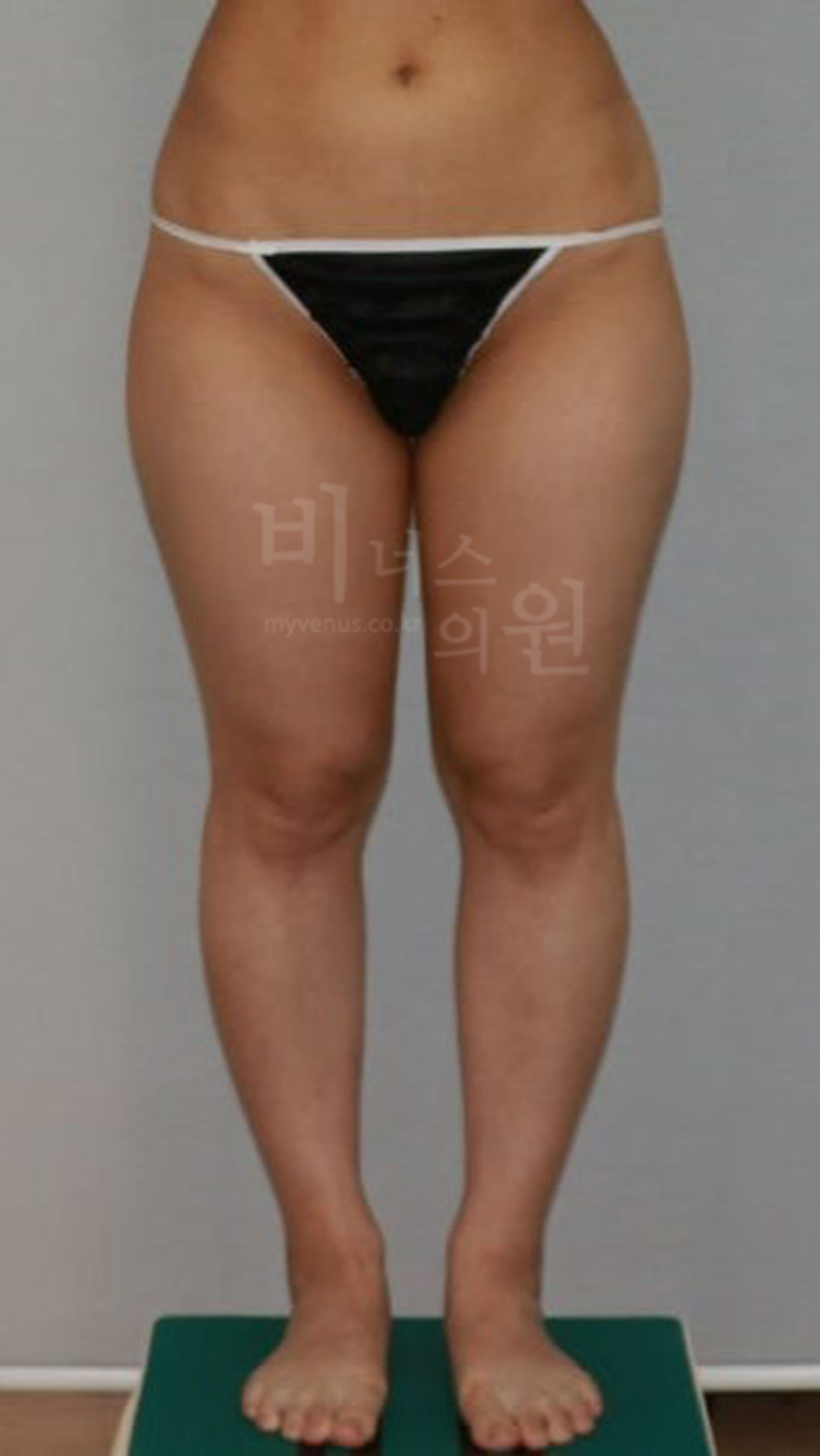 하체 비만 지방흡입.jpg