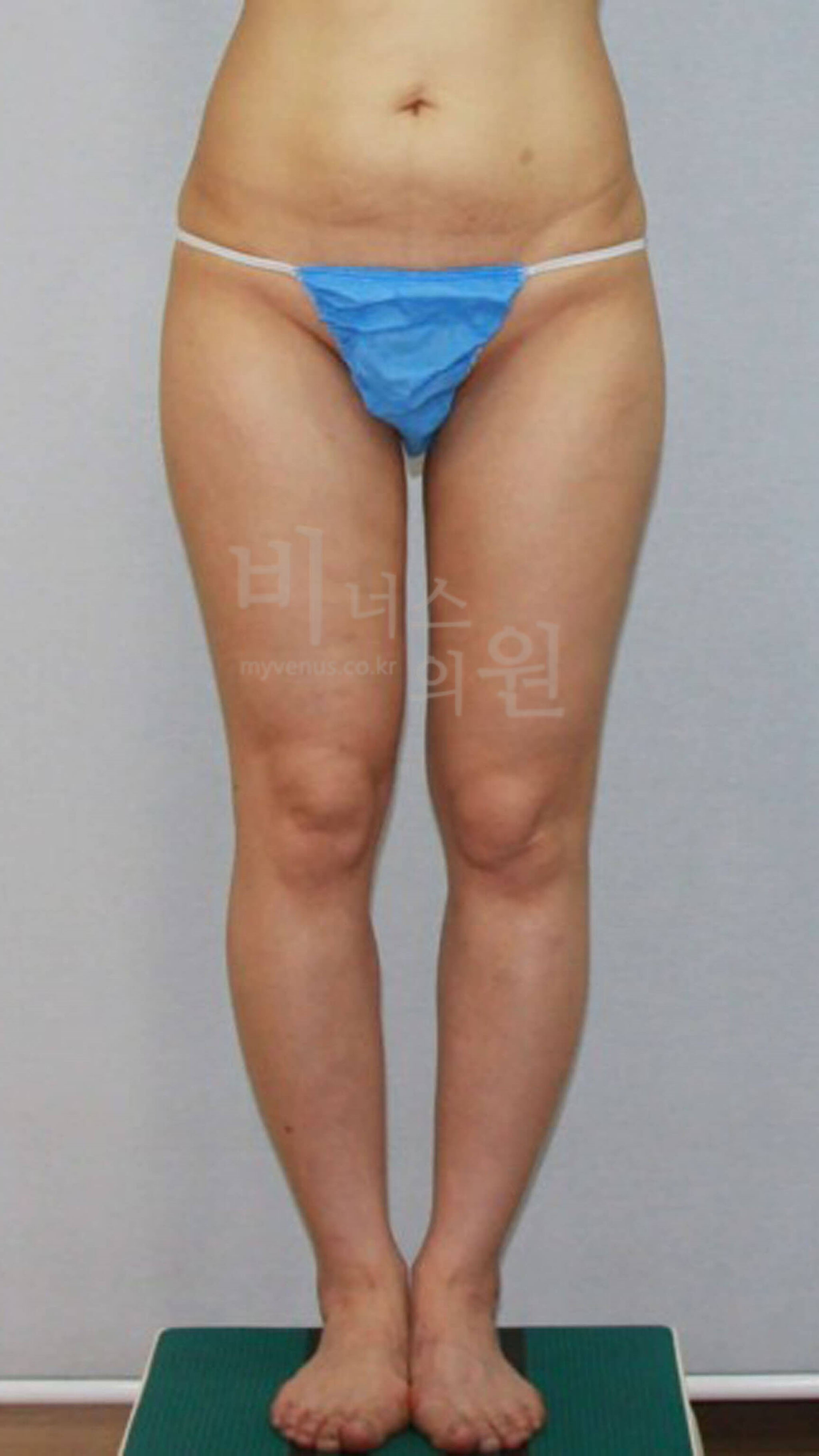 허벅지 엉덩이 지방이식.jpg