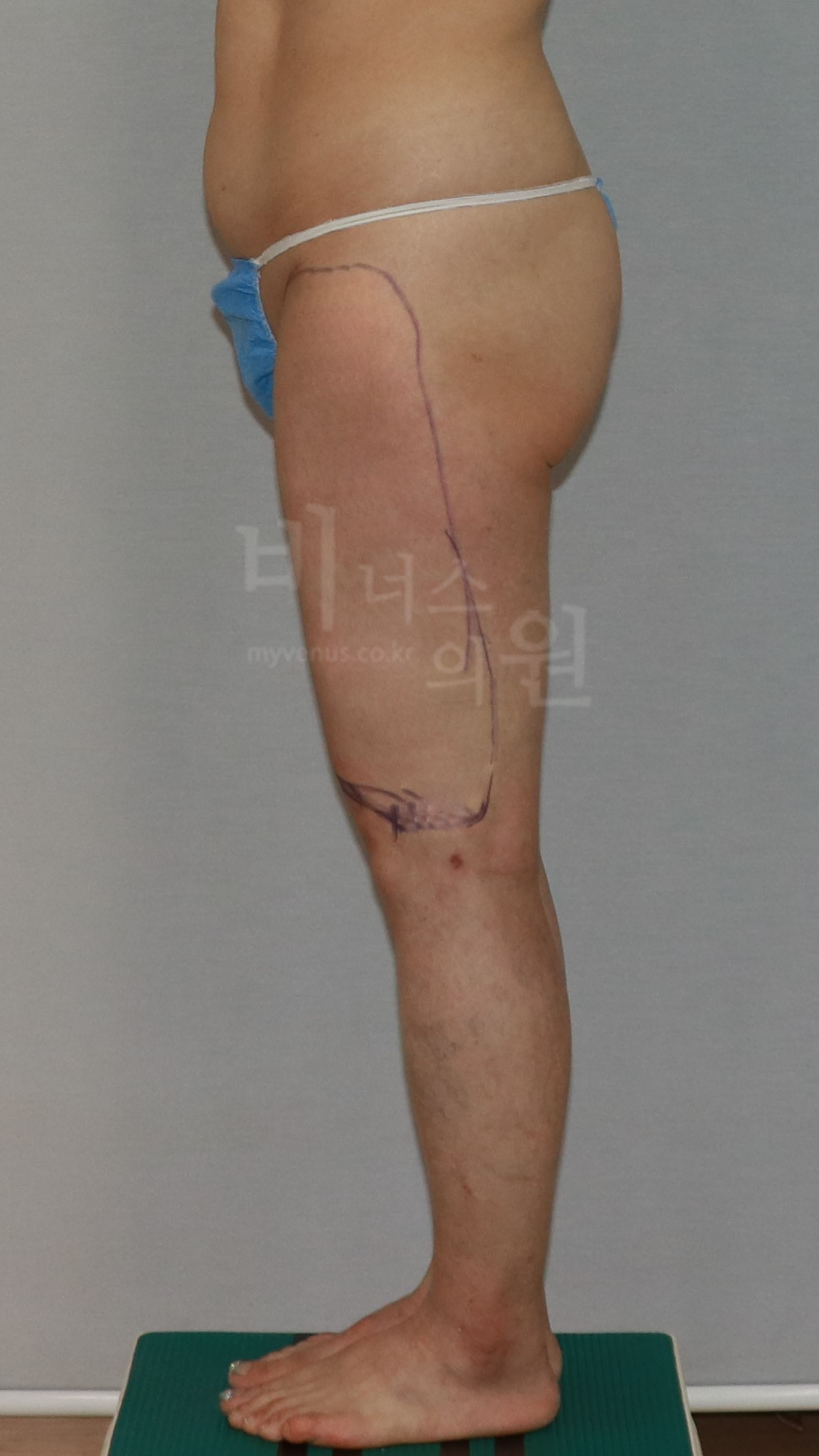 허벅지 미니 지방흡입.jpg