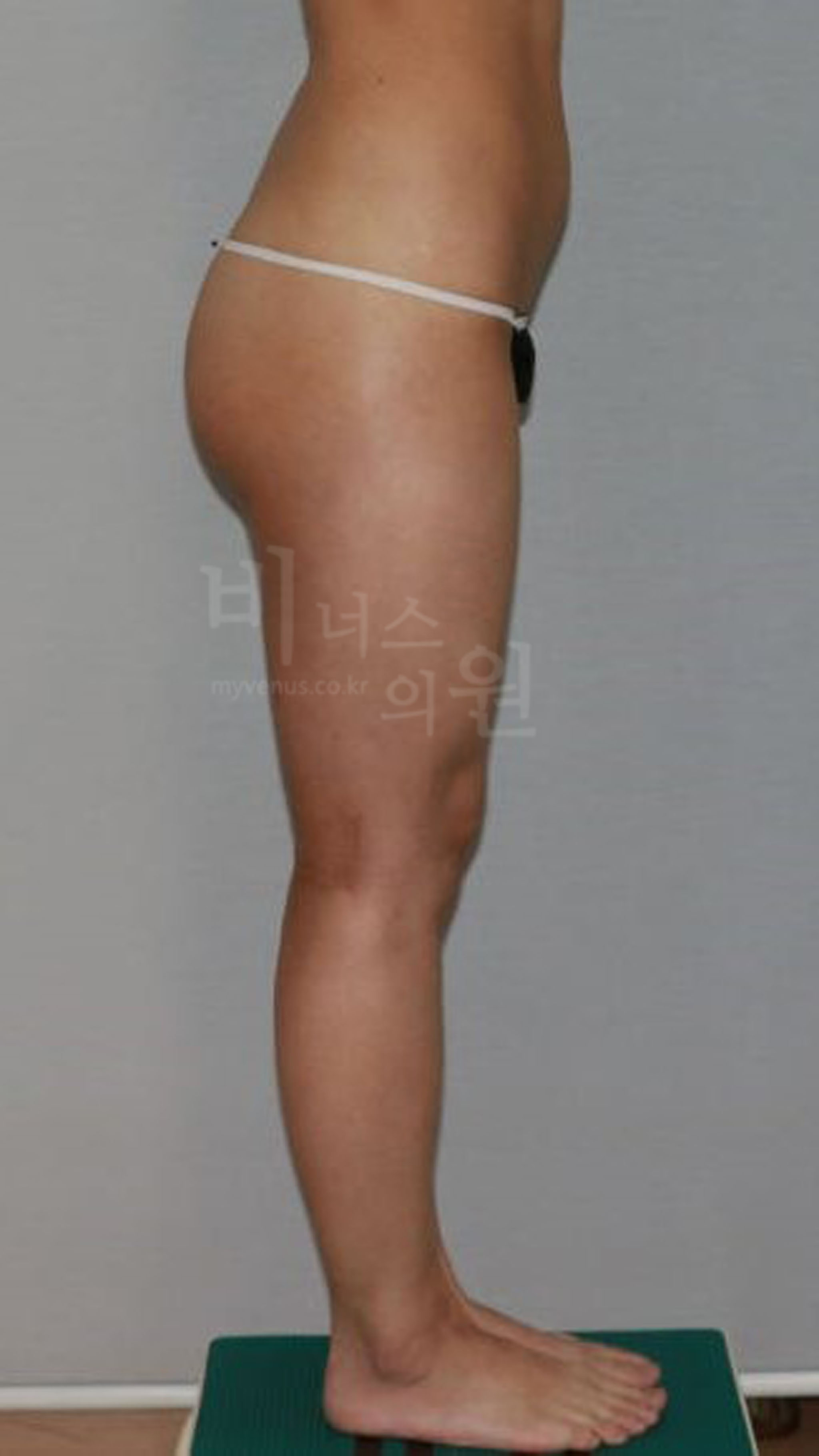 엉덩이 지방흡입.jpg