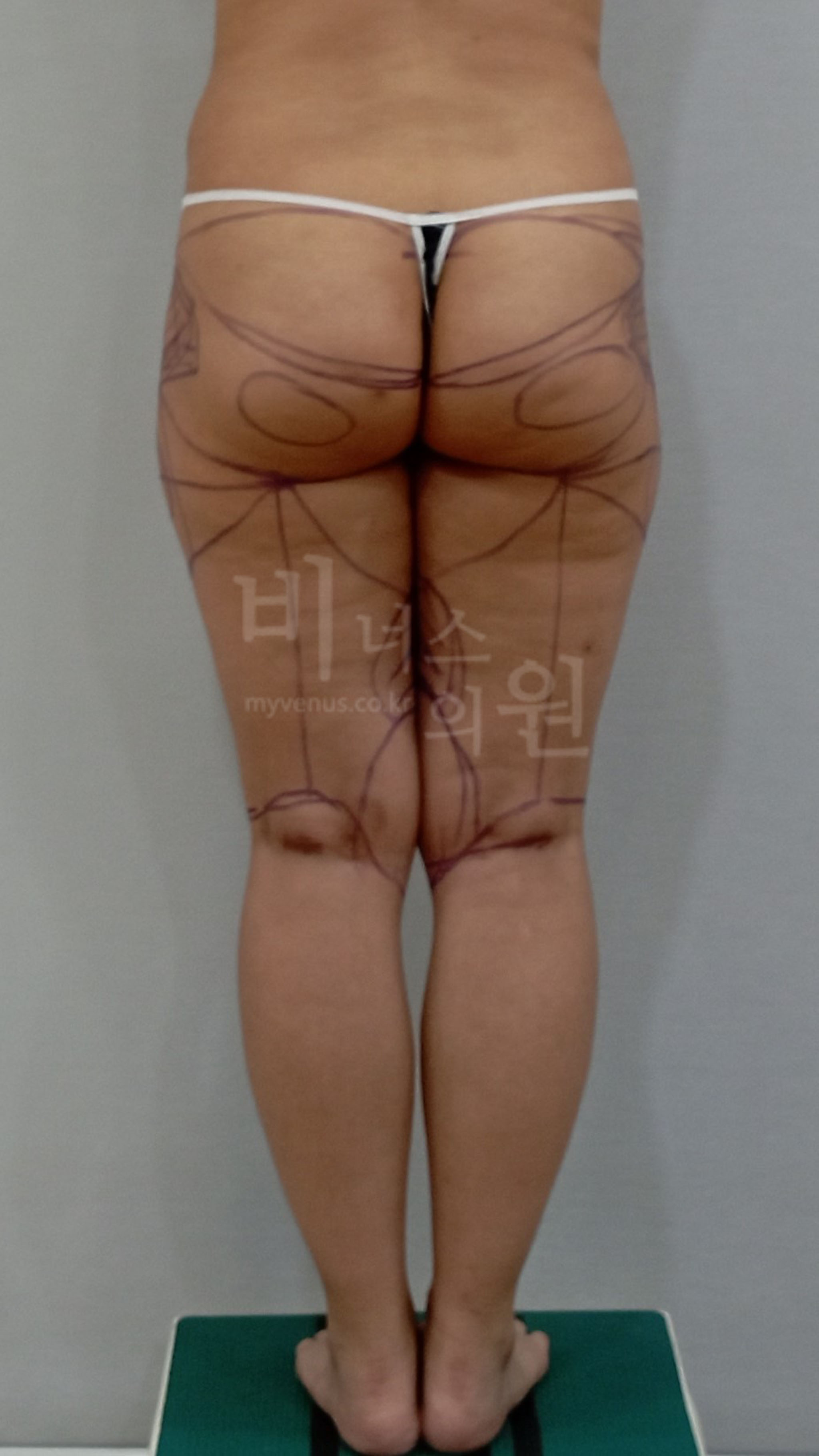 엉덩이지방흡입.jpg