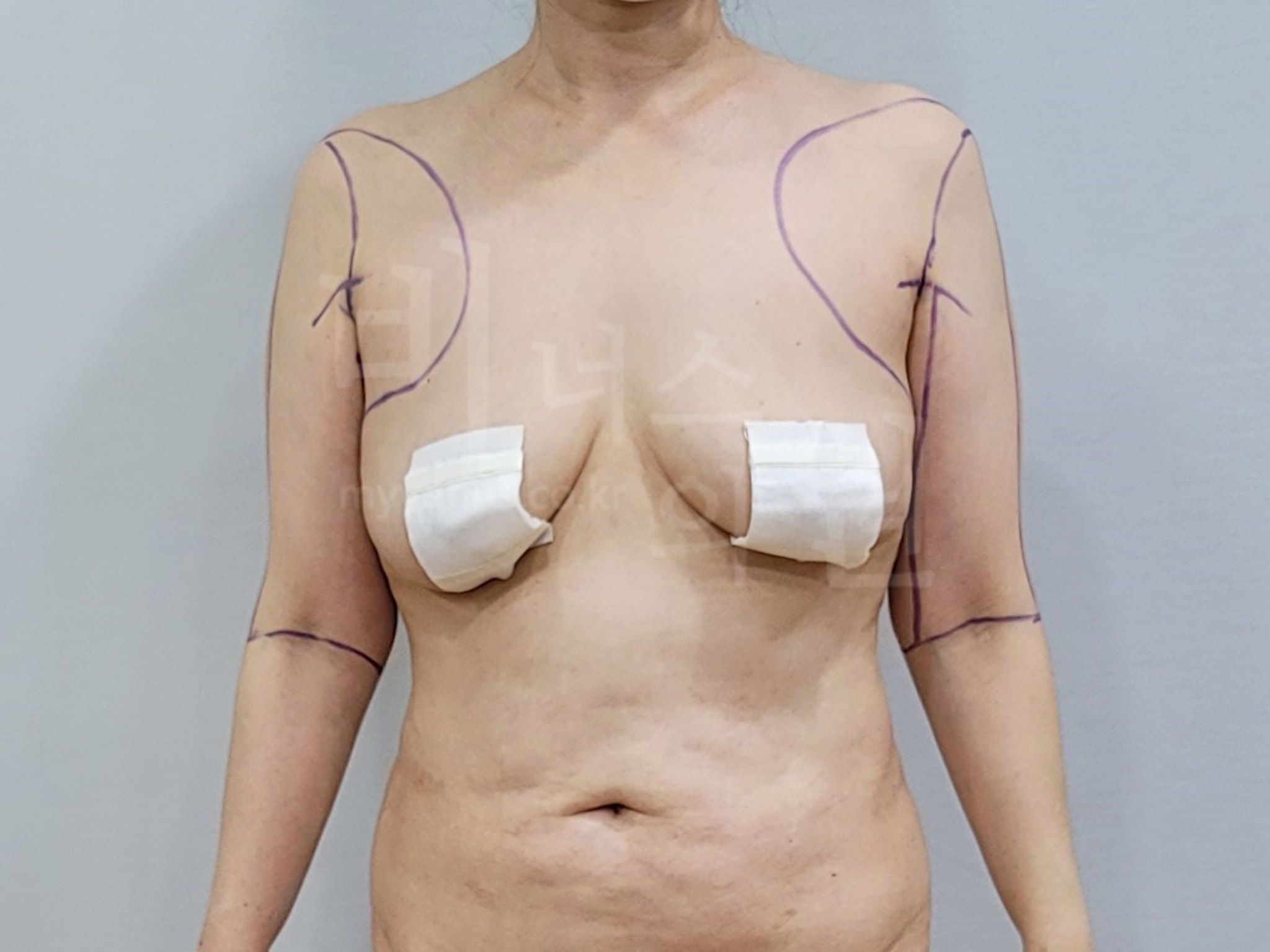 중년 팔 처짐.jpg