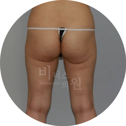 승마살 지방흡입.jpg