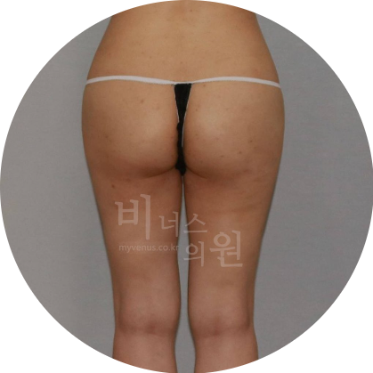 엉덩이 주름.jpg