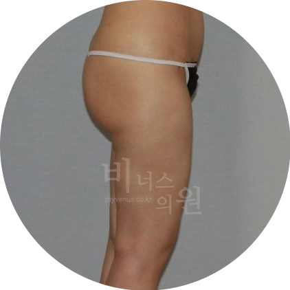 엉덩이 주름 지방이식.jpg