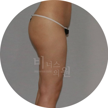 엉덩이 지방이식.jpg