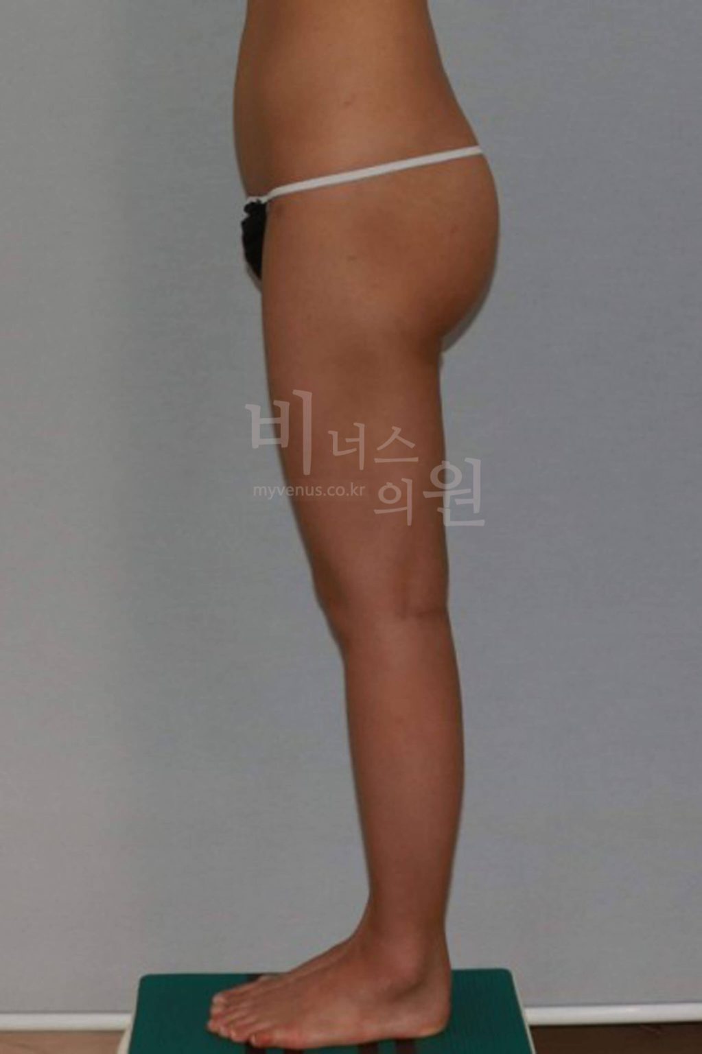 골반 지방이식.jpg