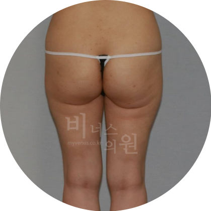 엉덩이 지방흡입.jpg