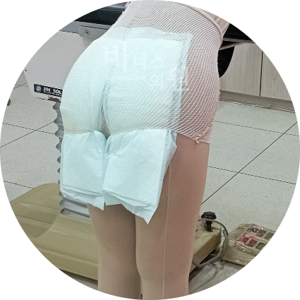 엉덩이 지방이식.jpg