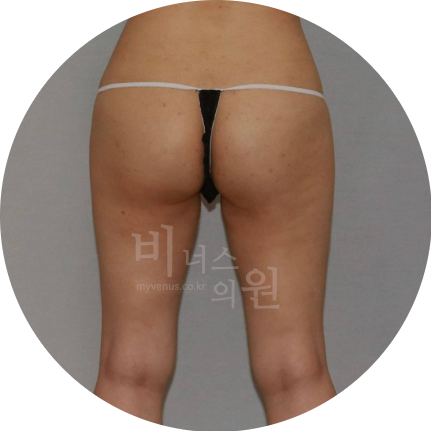 힙업 지방흡입.jpg