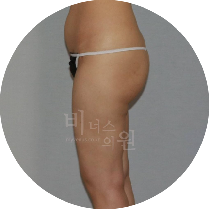 엉덩이 주름 지방이식.jpg