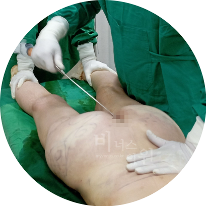 엉덩이 주름 지방이식.jpg