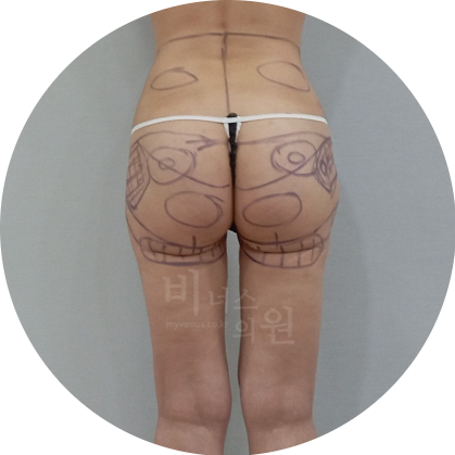 엉덩이 지방이식.jpg