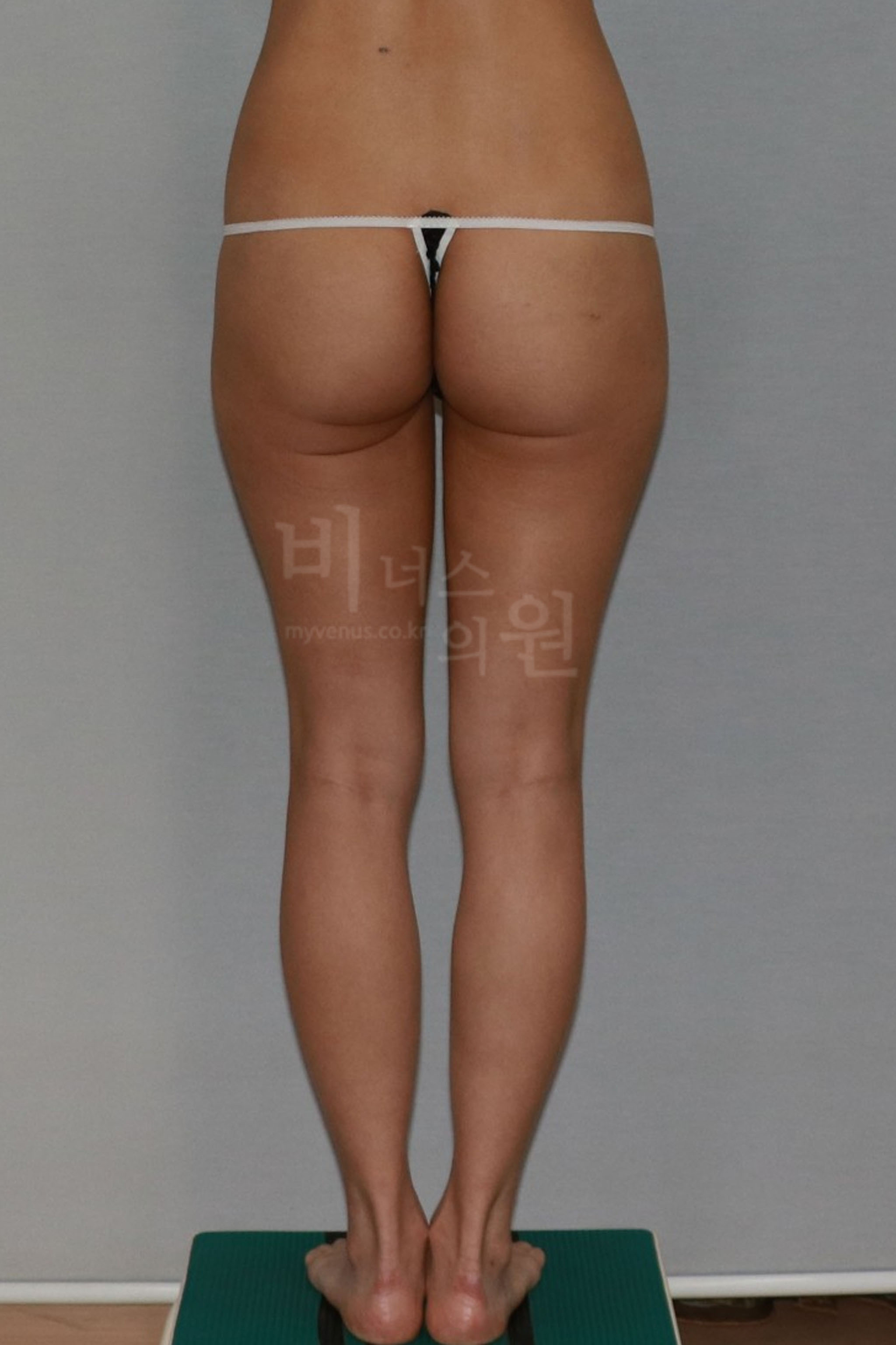 하체 비만 지방흡입.jpg