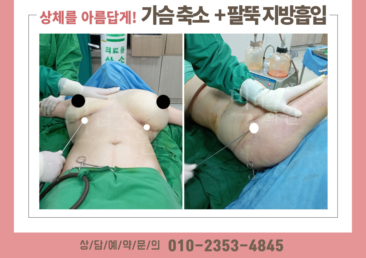상체 지방흡입.jpg