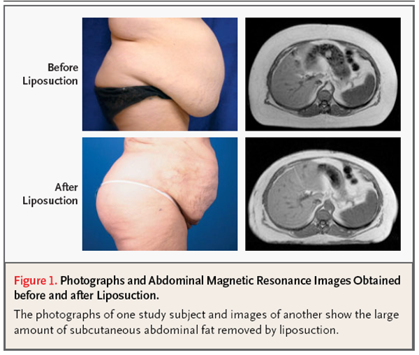 liposuction_ct.png