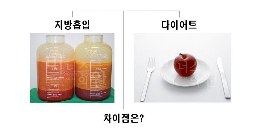 지방흡입 vs 다이어트