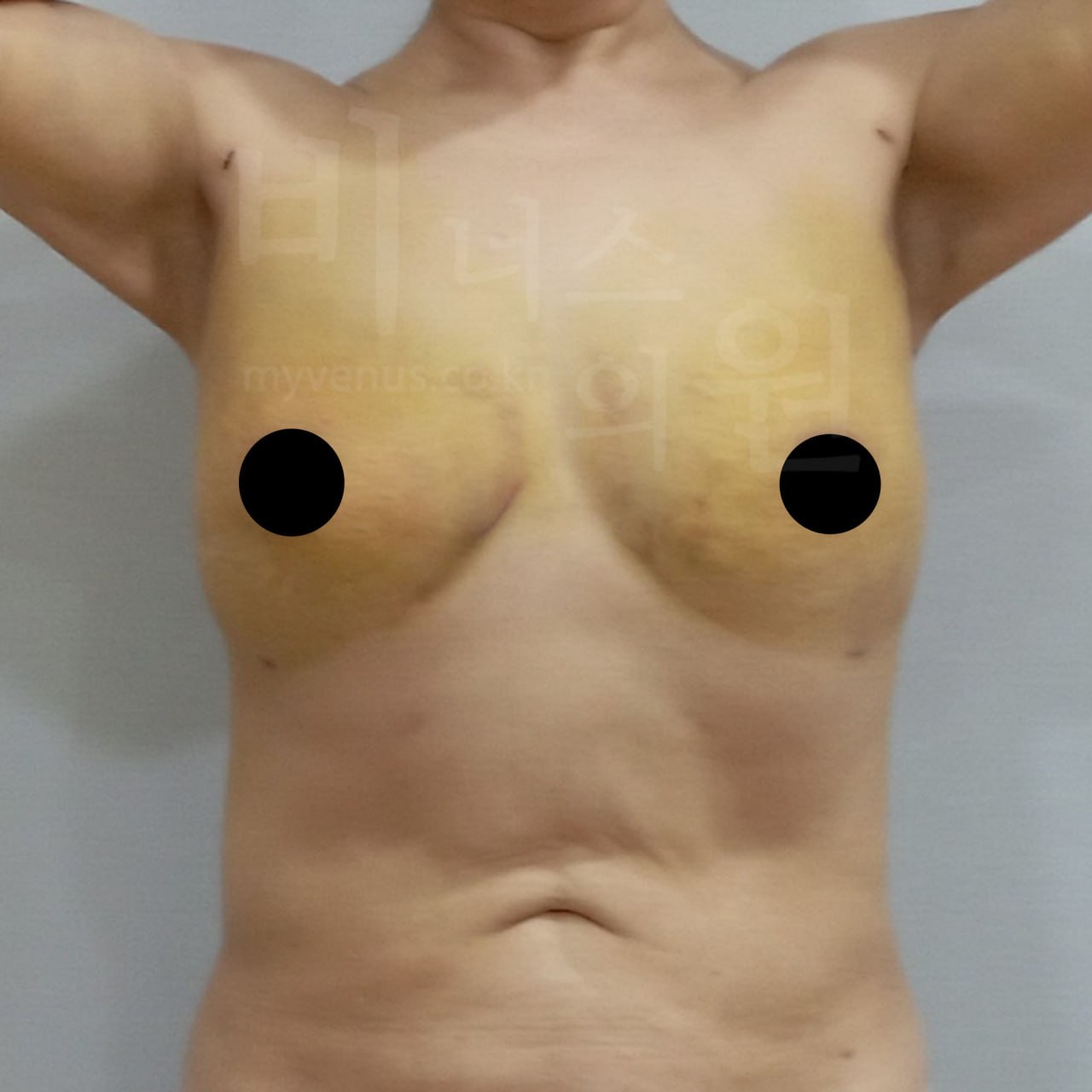 가슴축소 지방흡입 후 정면 비너스의원