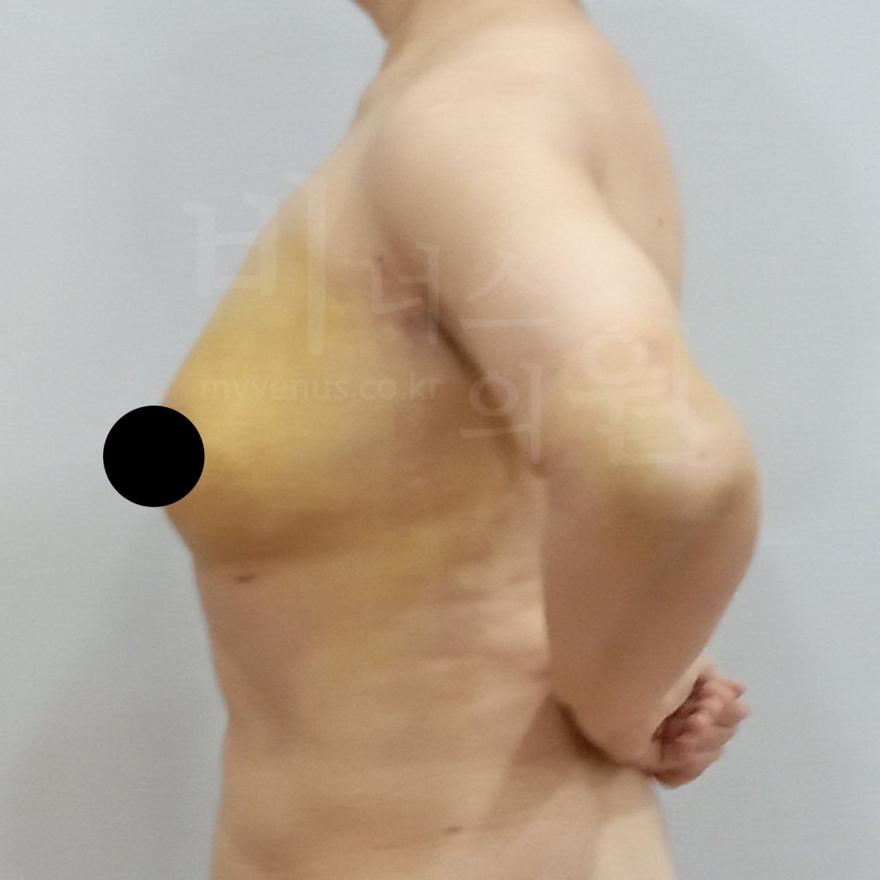 가슴축소 지방흡입 후 측면 비너스의원
