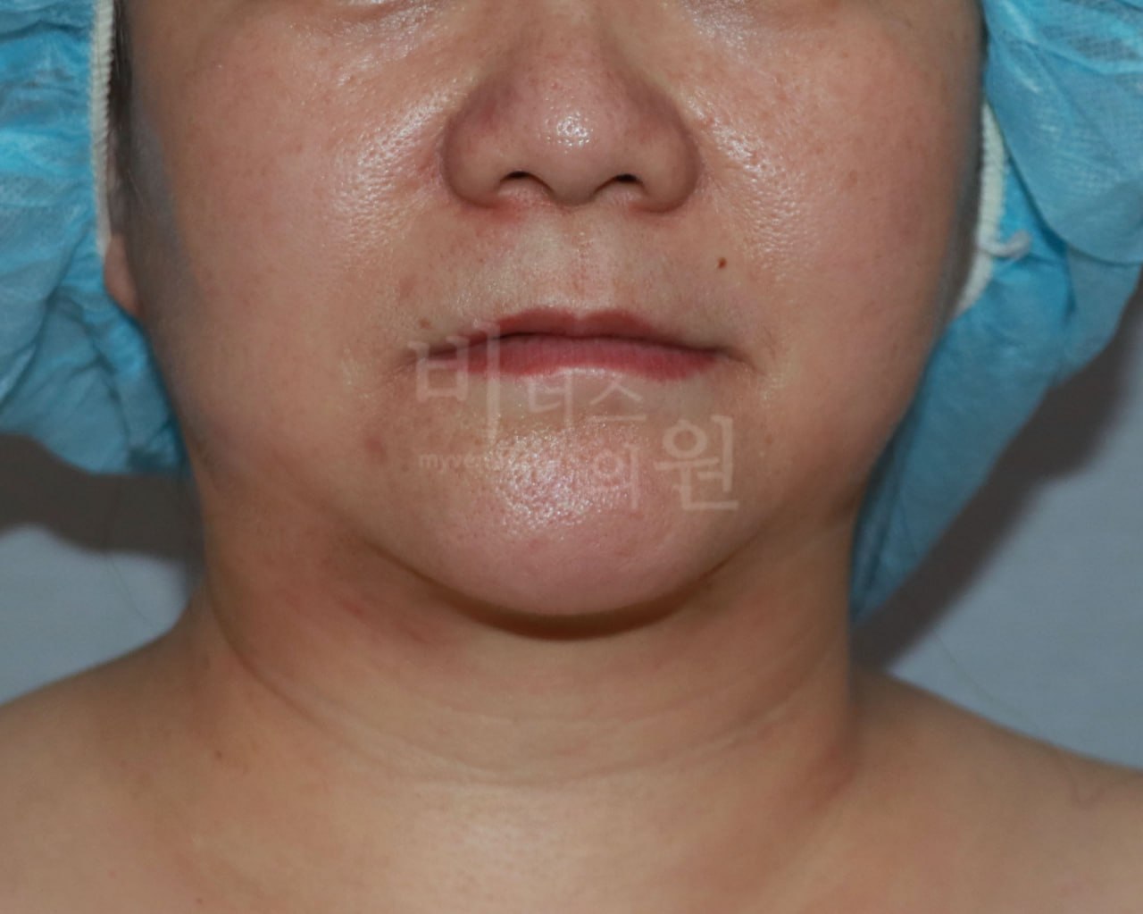턱지방흡입 후 정면 비너스의원