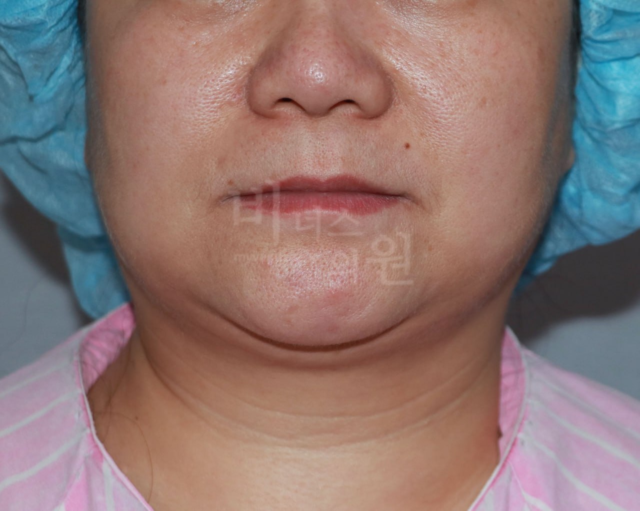 턱지방흡입 전 정면 비너스의원