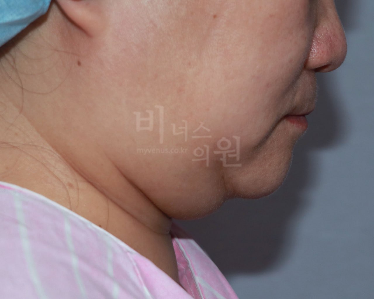 턱지방흡입 전 측면 비너스의원