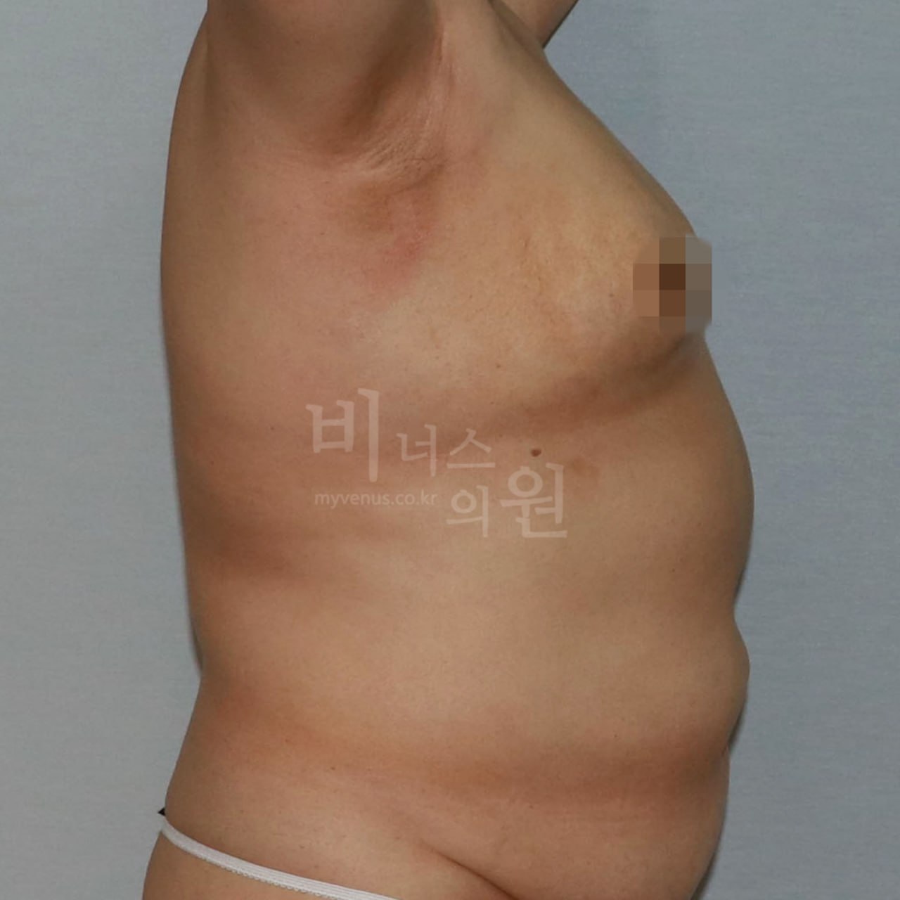 가슴 지방흡입 수술 후 측면 비너스의원