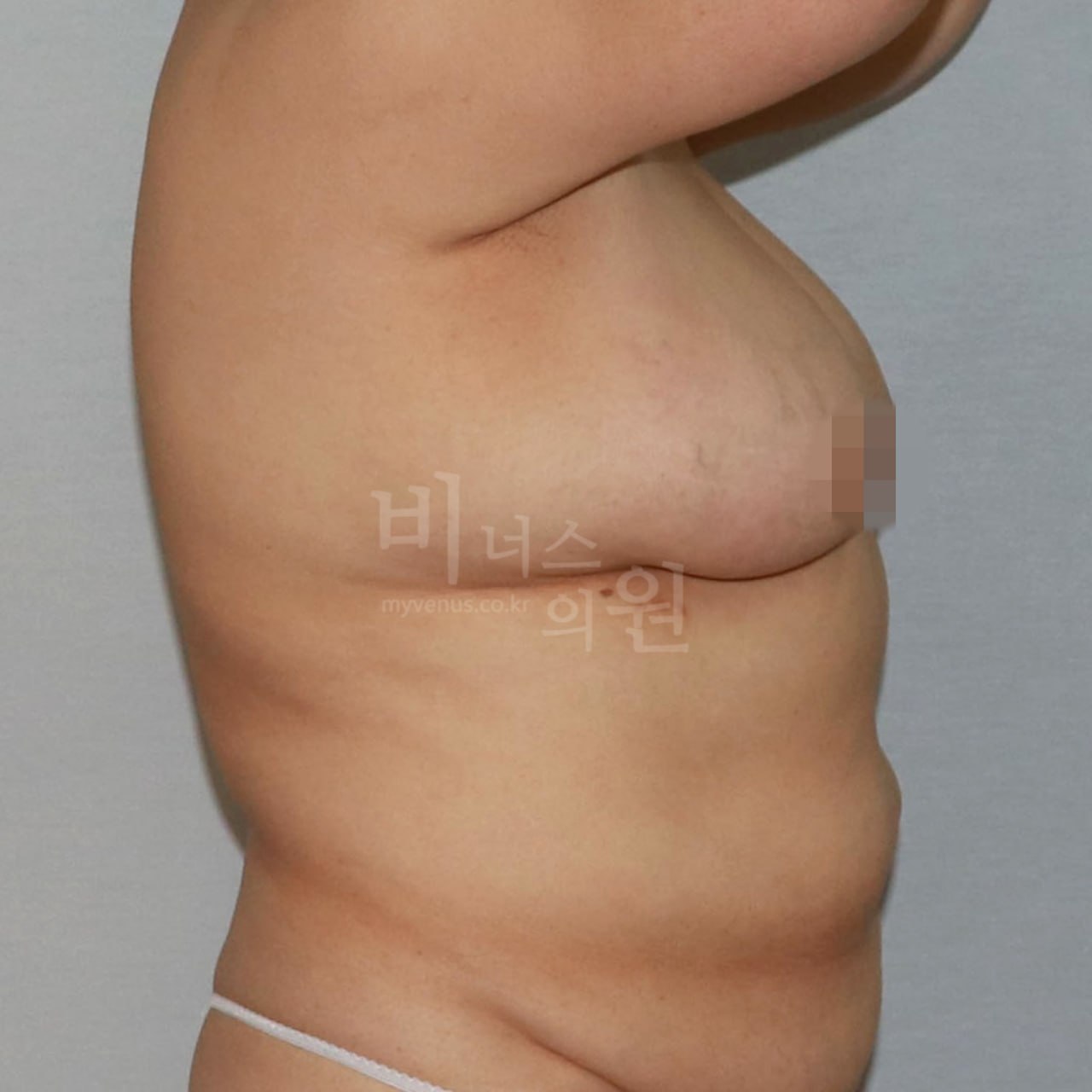 가슴 지방흡입 수술 전 측면 비너스의원