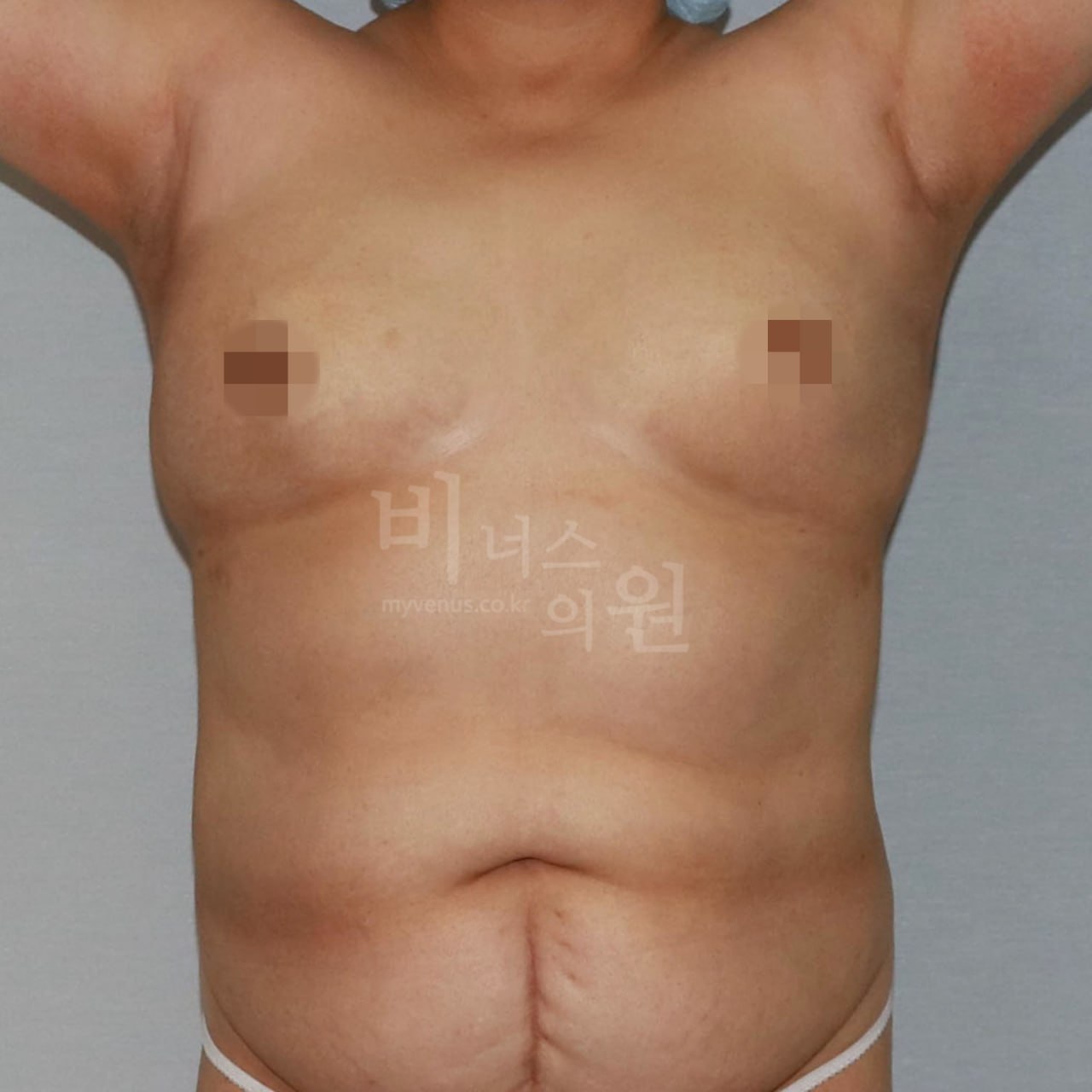 가슴 지방흡입 수술 후 정면 비너스의원