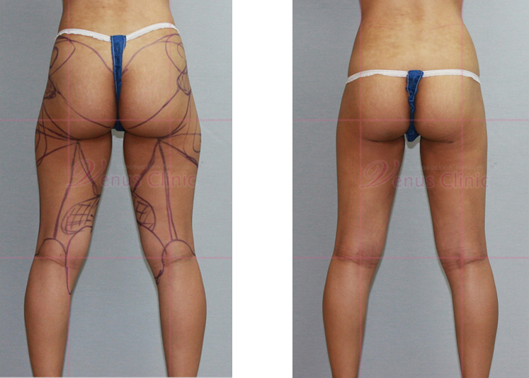 허벅지 지방흡입 전후사진 뒷면