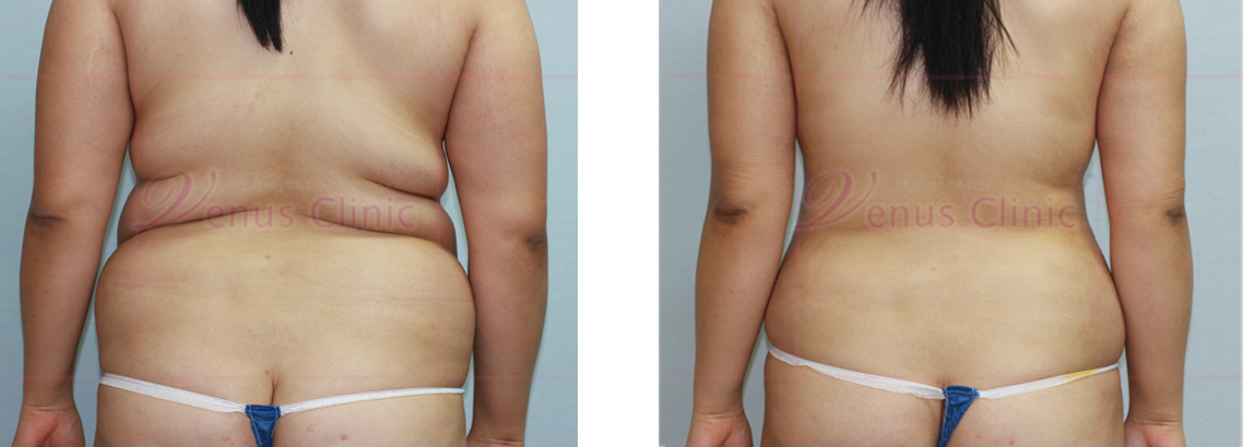 복부 지방흡입 전후사진3