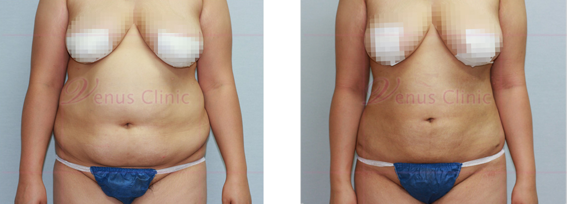 복부 지방흡입 전후사진1