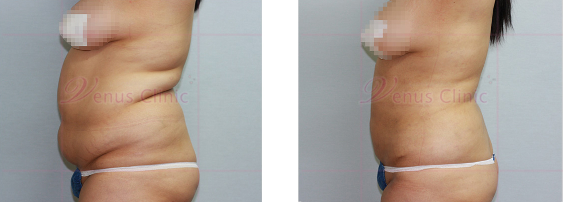복부 지방흡입 전후사진2