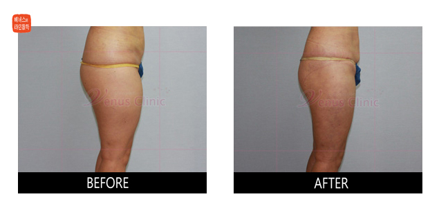 전측 허벅지 지방흡입 전후사진