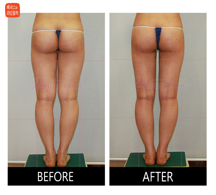 힙,엉덩이,외측허벅지 지방흡입