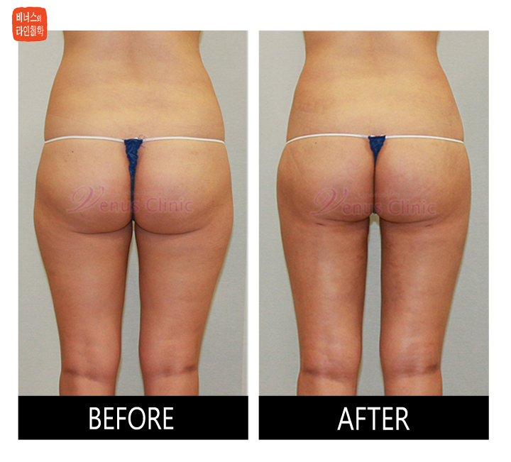 엉덩이 지방흡입