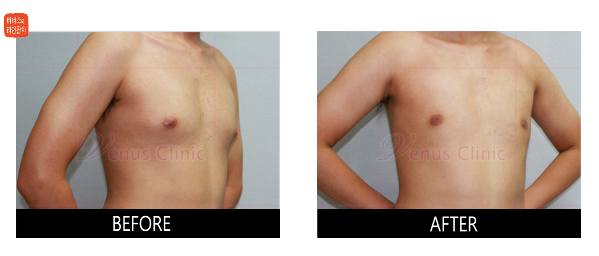 여성형 유방증 지방흡입 사진