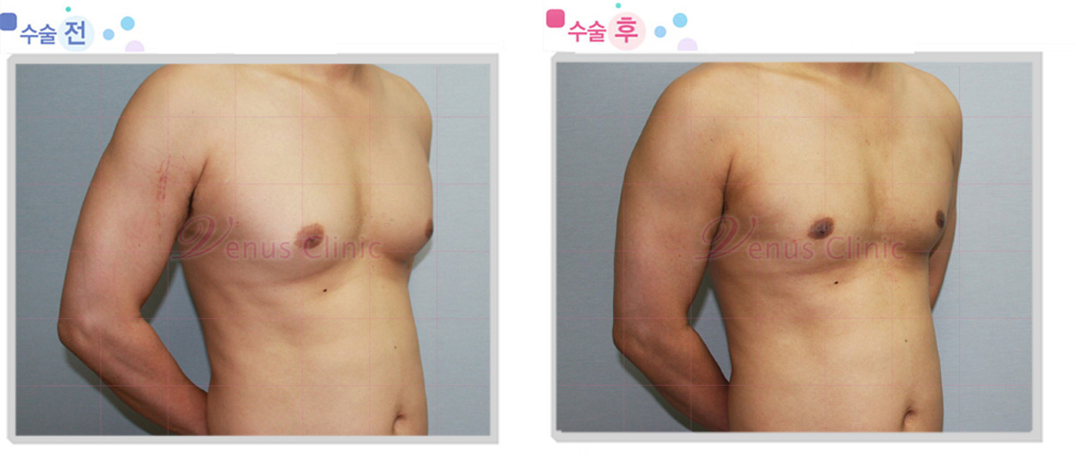 여유증 전후사진2 여유증 전후사진2