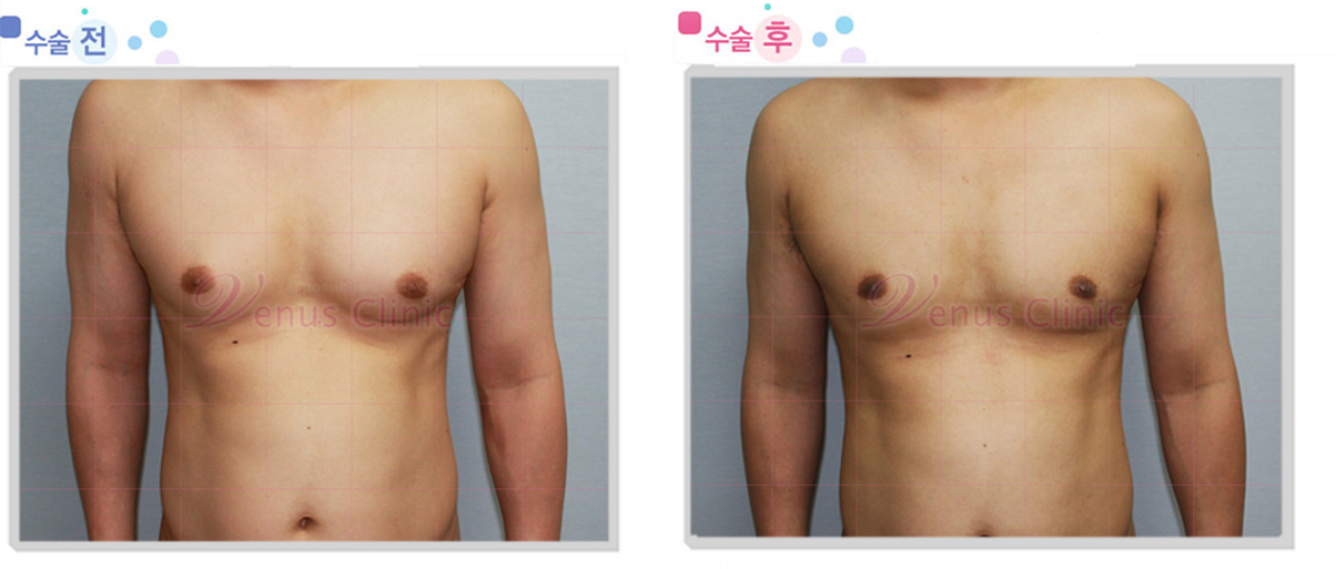 여유증 전후사진2