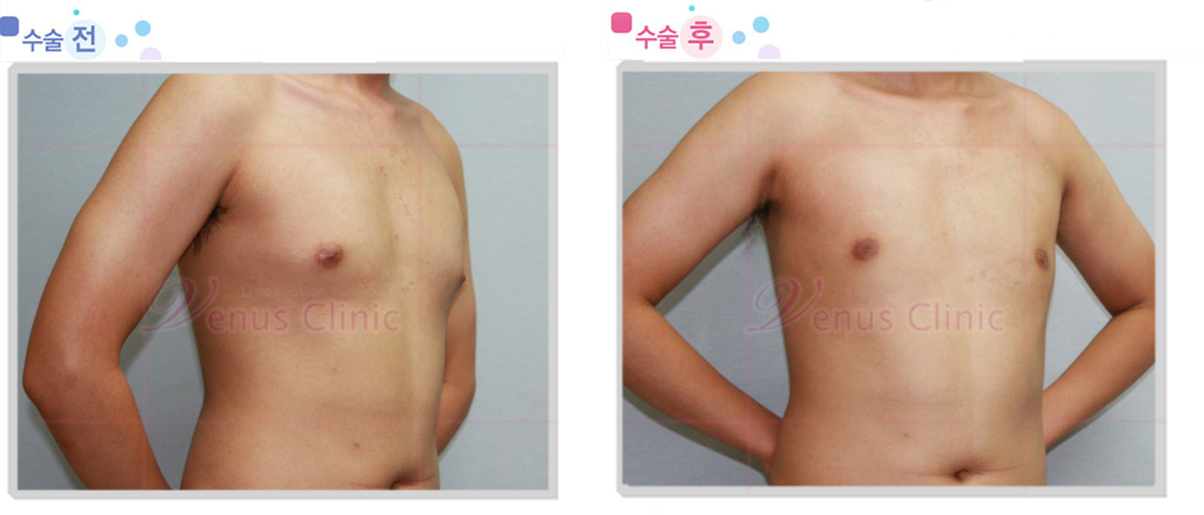 여유증 전후사진1 여유증 전후사진1