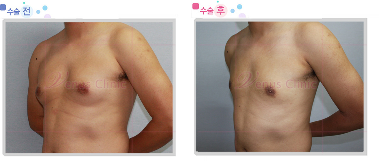 여유증 전후사진3 여유증 전후사진3