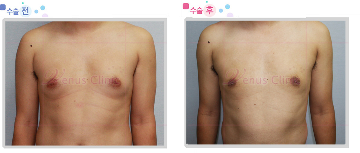 여유증 전후사진3
