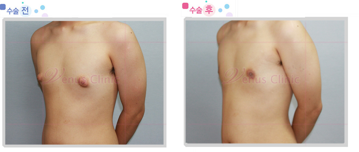 여유증 전후사진4