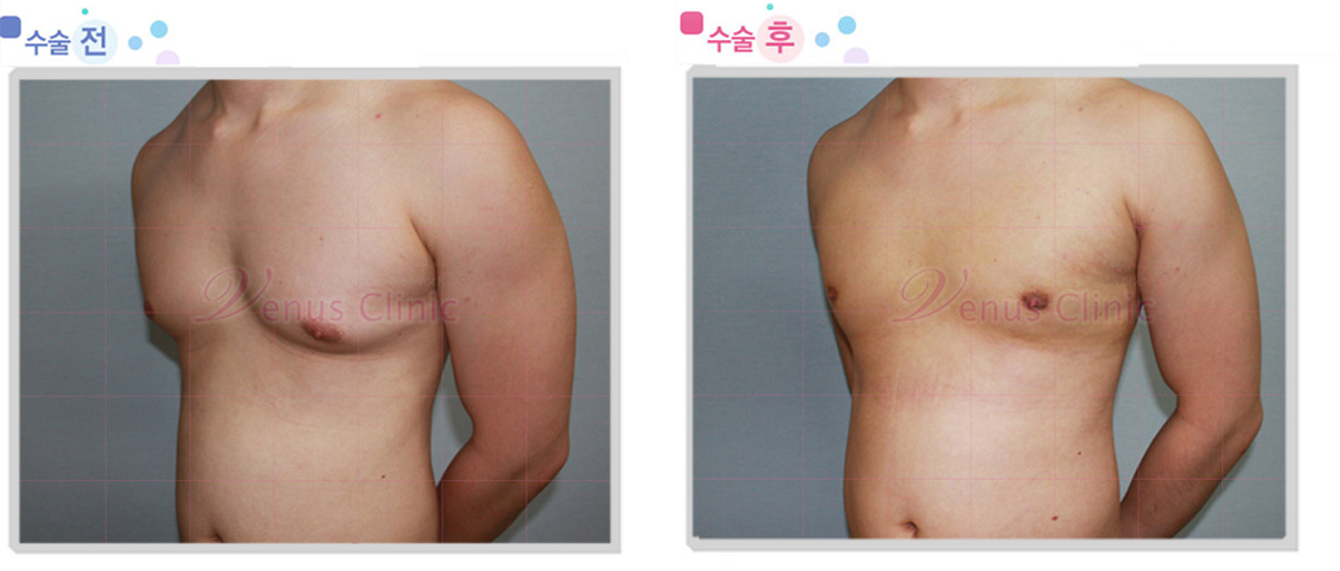 여유증 전후사진5