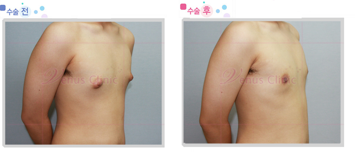 여유증 전후사진4 여유증 전후사진4