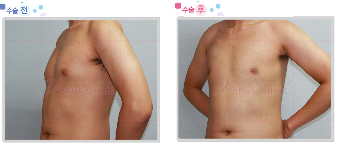 여유증 전후사진1