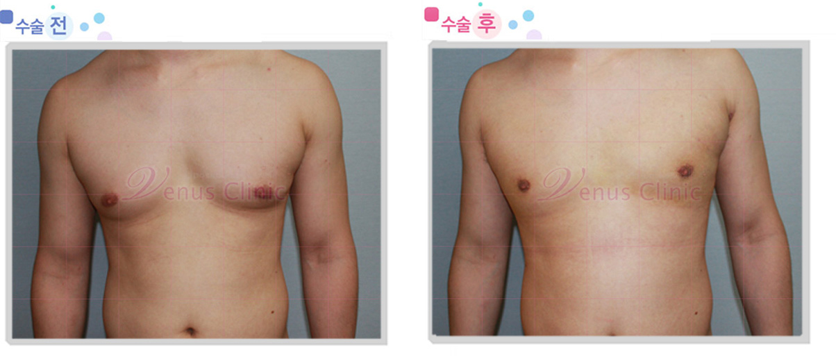 여유증 전후사진5