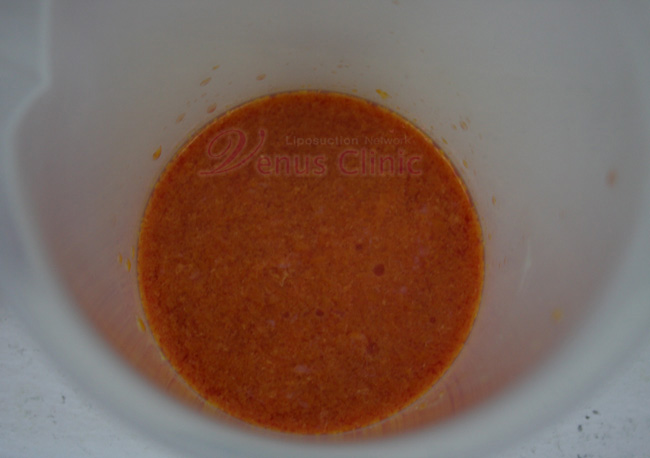 여유증 흡입된 지방사진1 여유증 흡입된 지방사진1